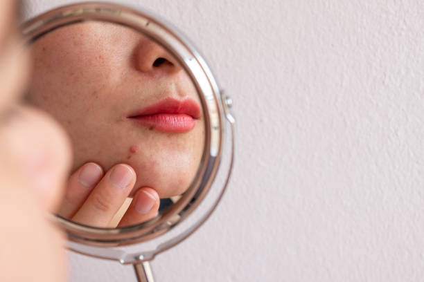 Hormonal acne