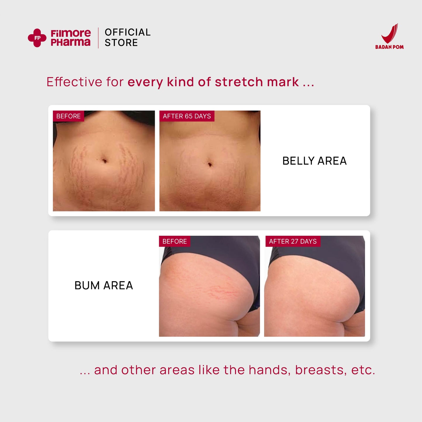 Filmore Regenfil Stretch Mark Cream with REGESTRIL™